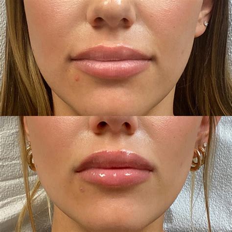 lip filler reviews